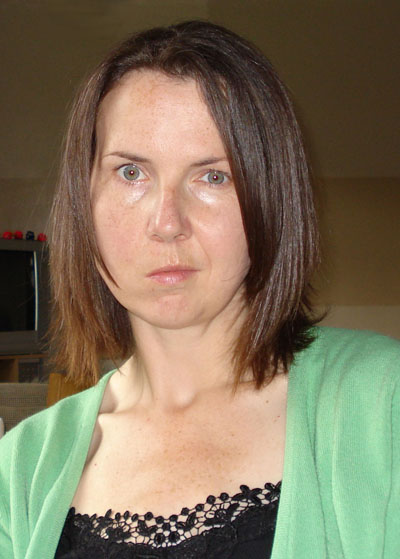 Nicola after Bell's palsy